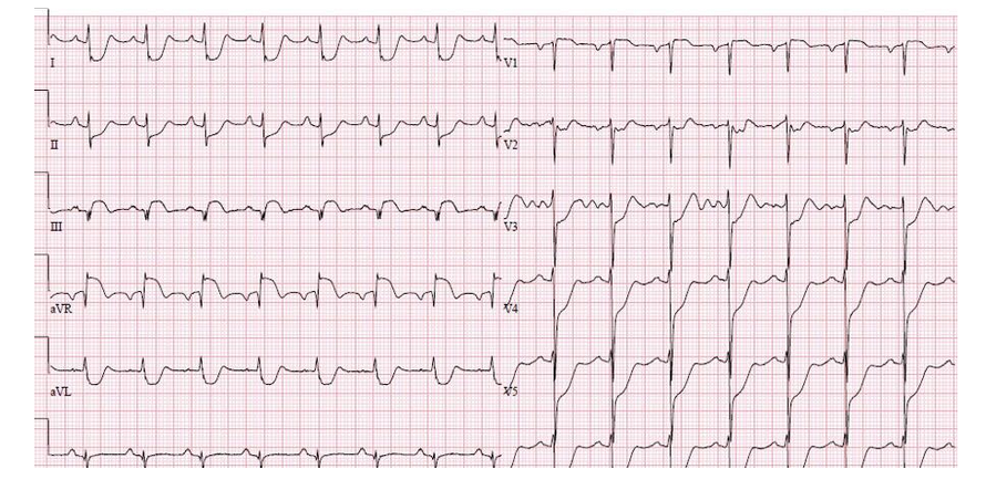 ecg8.PNG