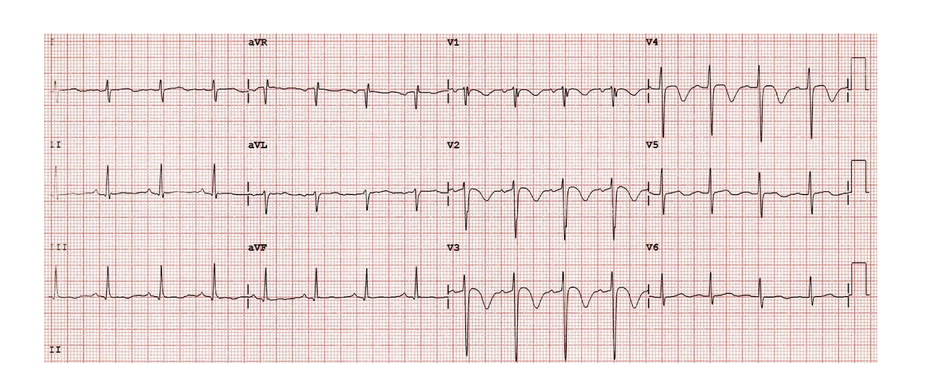 ecg7.PNG