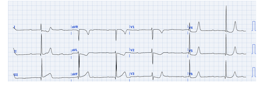 ecg6.PNG