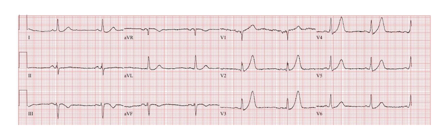 ecg5.PNG