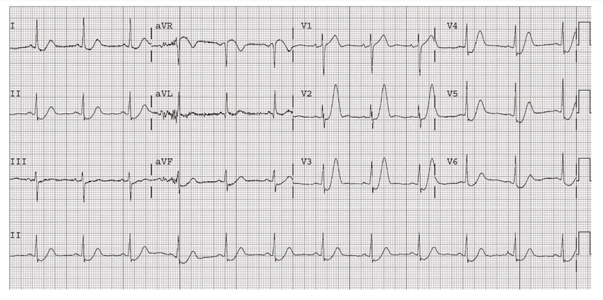 ecg4.PNG