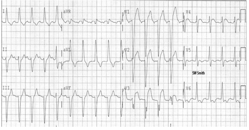 ecg3.PNG