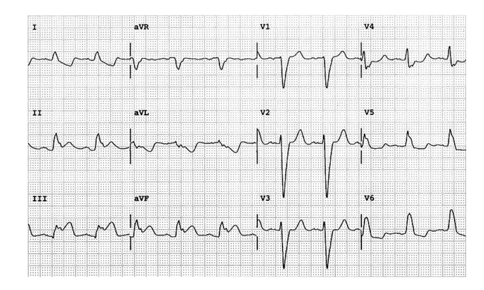 ecg2.PNG