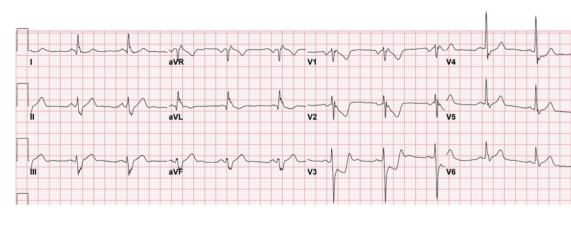 ecg1.PNG