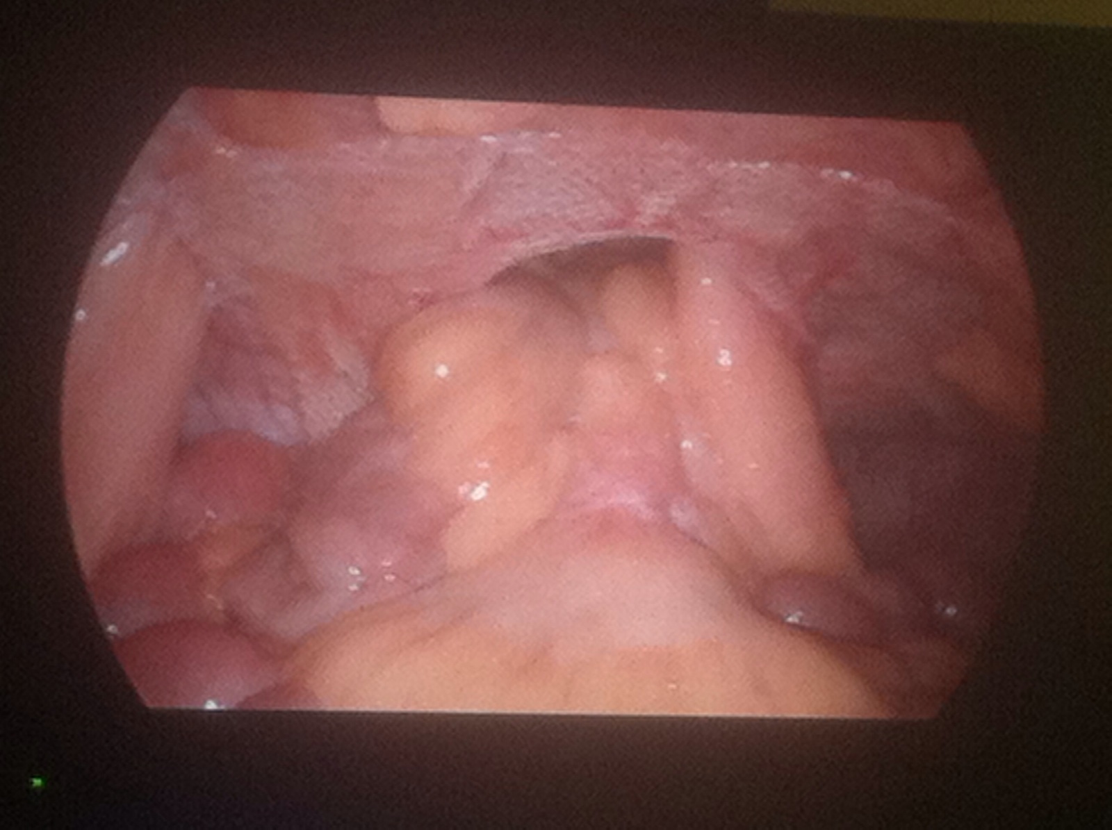 éventration sur iléostomie 2