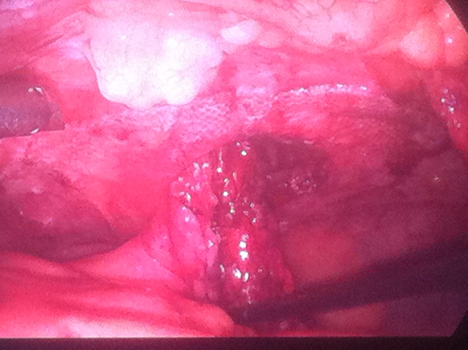 éventration sur iléostomie 3