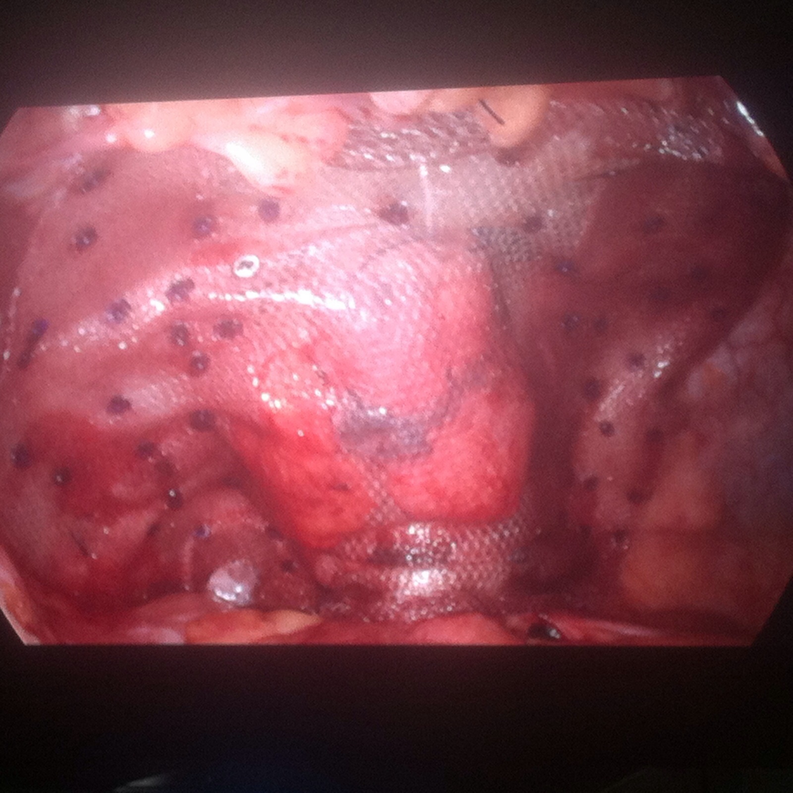 éventration sur iléostomie 4 (1)